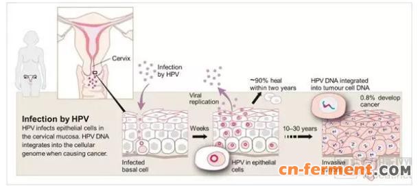 hpv病毒感染后宫颈癌疾病发展示意图